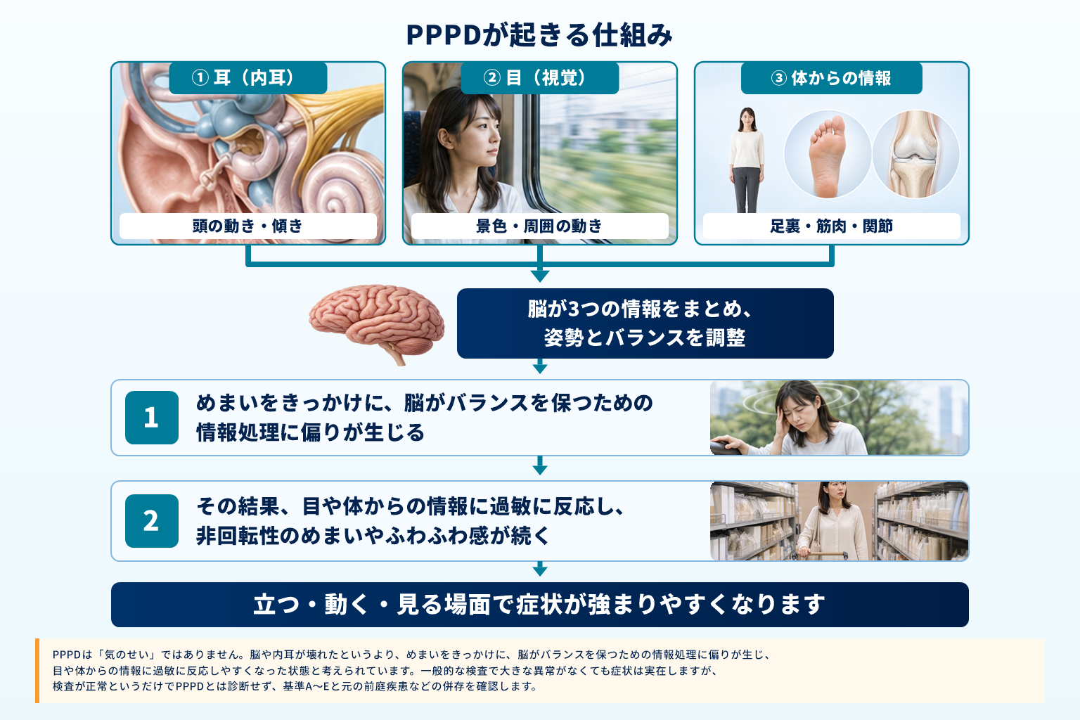 内耳・視覚・体からの情報を脳で統合し、めまいをきっかけにバランス情報の処理に偏りが生じ、非回転性めまいやふわふわ感が起きる仕組みを実写と医療CGで示したPPPD図解
